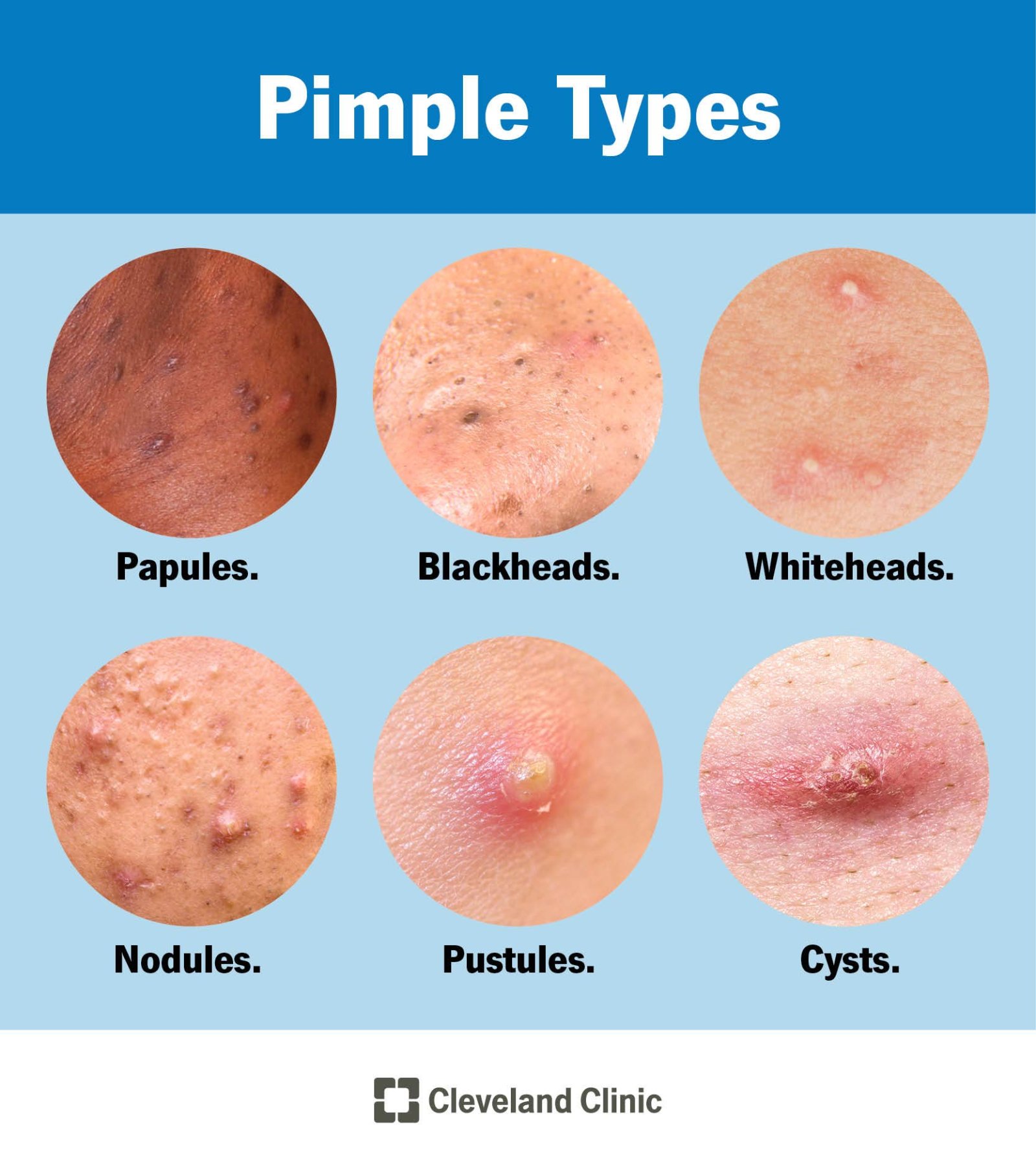 22468-pimples.jpg