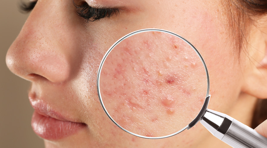 900x500_banner_HK-Connect_Early-signs-of-acne.jpg
