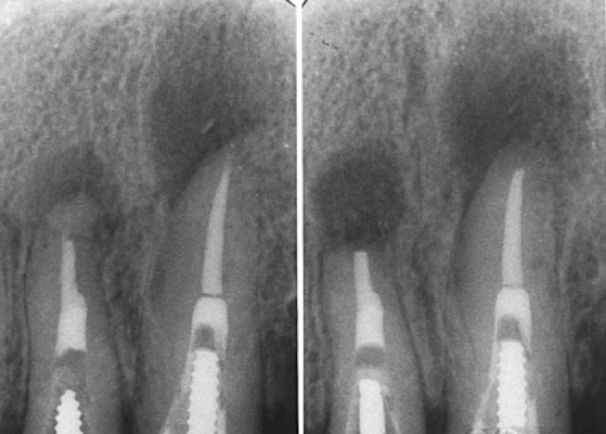 Successful-surgery-with-failed-endodontic-re-treatment-Preoperative-radiograph-a-shows.png