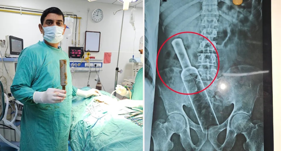 Đời sống - Đau bụng đi khám, bác sĩ sốc nặng khi chụp X-quang cho người đàn ông