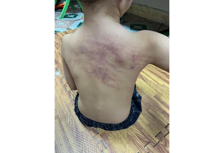 Hình ảnh cháu bé nghi bị bạo hành tại trường mầm non An Dương với nhiều vết bầm tím sau lưng. Ảnh gia đình cung cấp