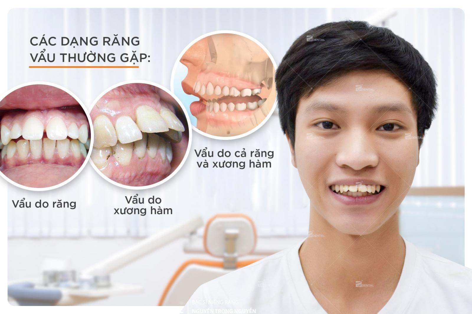 cac-dang-rang-mom-thuong-gap.jpg