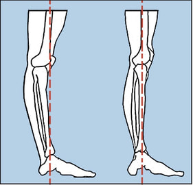 9-hyper-extended-knee.jpg