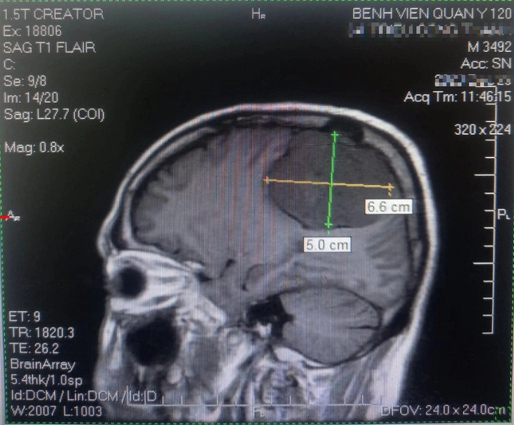 Hình ảnh chụp MRI cho thấy khối u có kích thước khổng lồ lấn sâu vào não - Ảnh: NGỌC CƯỜNG