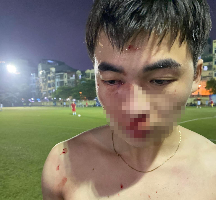Hình ảnh anh Đinh Xuân Dương bị thương vùng mặt sau trận bóng phủi - Ảnh: Nhân vật cung cấp