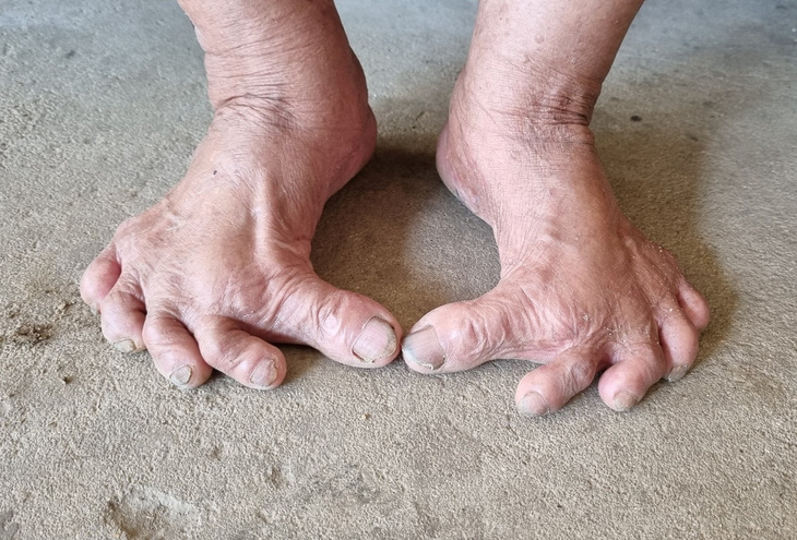 Ngón chân cong kỳ lạ của bà Huyên, một đặc điểm giống với bàn chân Giao Chỉ của người Việt cổ được sử sách ghi lại - Ảnh: TRẦN MAI