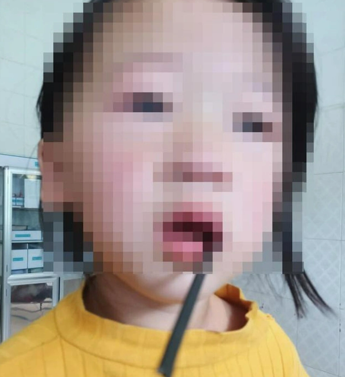 Bé gái 4 tuổi bị thanh sắt đâm xuyên miệng trong lúc chơi đùa - 1