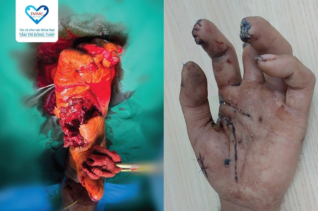 Bàn tay trái bị dập nát trước và sau phẫu thuật